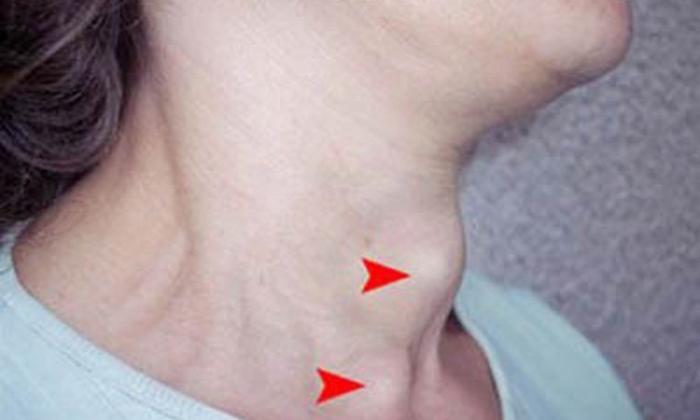 5 hiện tượng lạ ở vùng cổ cảnh báo nguy cơ mắc K tuyến giáp, gặp 1/5 cũng đáng lo ngại, cần đi khám